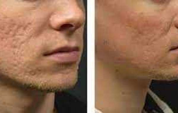 Micro Needling For Acne Scars