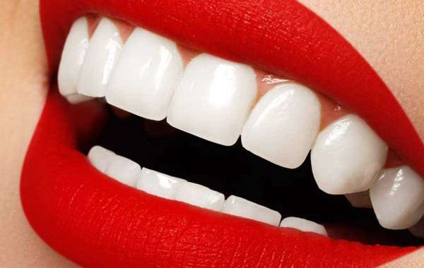 Enhance Your Smile with Dental Veneers in Dubai: Achieving a Dazzling Smile Makeover