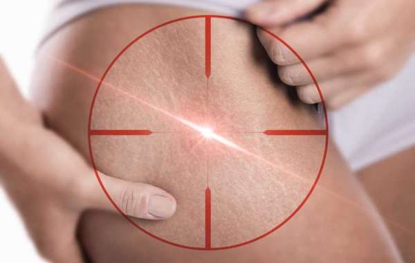 Say Goodbye to Stretch Marks with Laser Removal in Dubai: Regain Smooth and Flawless Skin