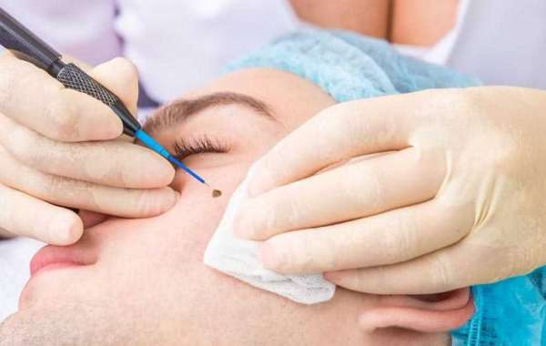 Why Consider Mole and Skin Tag Removal?