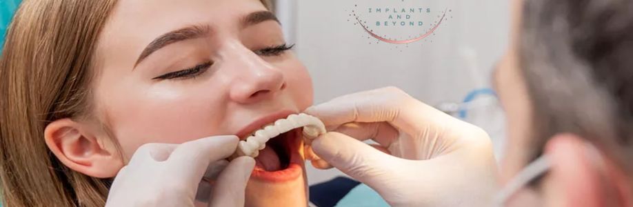 All-on-6 Implants VS Dental Impl Cover Image